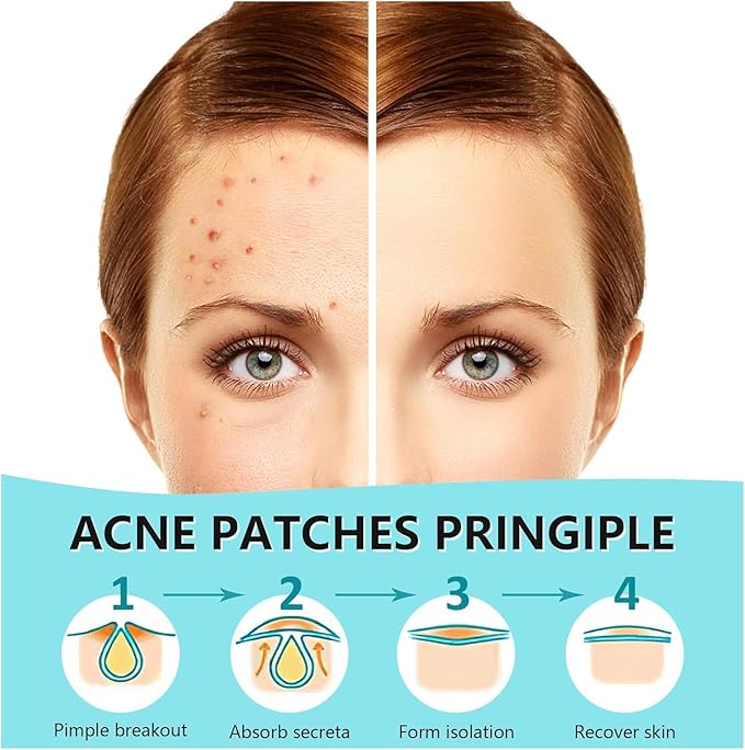 PICcircuit Pimple Patches for Face, Hydrocolloid Acne Patches, Invisible Zit Patches for Face, Acne Spot Treatment Patch Cystic Blemish Patches Zit Stickers for all Skin Colors (360 Counts)